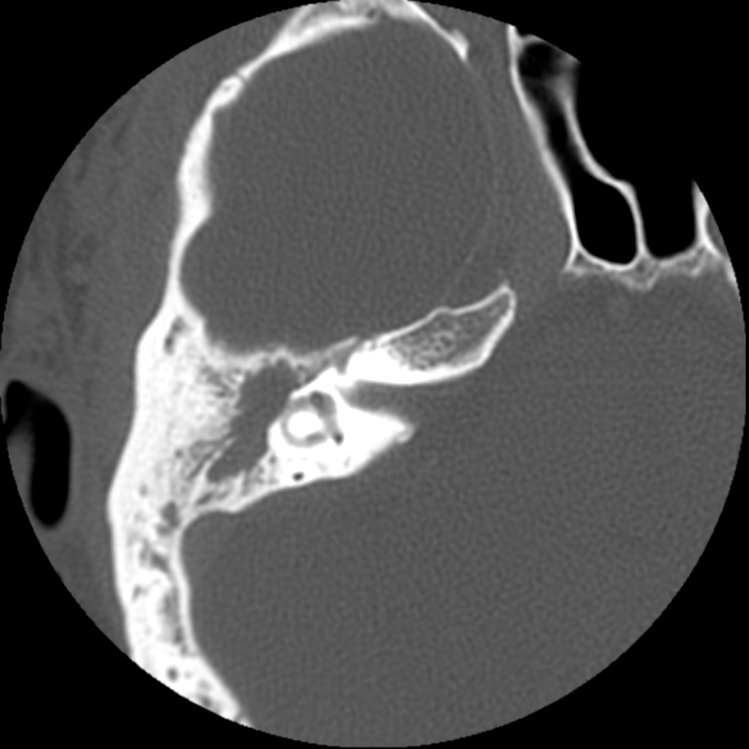 Erosion of the bony covering of the lateral semicircular canal Lateral semicircular canal fistula. Axial CT scan showing widespread opacification of the middle ear cleft, with erosion of bone over the lateral semicircular canal