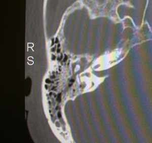 Fracture of the petrous temporal bone extending through the otic capsule Coronal CT scan of the temporal bones. The mastoid air cells are filled with blood. A fracture line is seen travelling through the otic capsule which has resulted in a complete vestibular and hearing loss on this side.