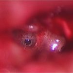 stapedotomy 0.5mm stapedotomy through the footplate of the stapes. It is through this hole that the new piston is placed, re-establishing a connection between the middle and inner ear