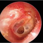 small_tympanic_membrane_perforation A small tympanic membrane perforation. This is of long standing, thus with no chance of spontaneous closure. In general terms, the larger the perforation the worse the hearing.