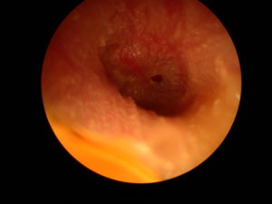 traumatic_perforation_surfing Small perforation in the tympanic membrane. There is evidence of co-existing infection. This perforation occured following a fall from a surfboard onto the water. Similar injuries can occur after a blow the the external ear due to a pressure wave created down the ear canal. If the infection can be cleared, most of these perforations heal spontaneously.