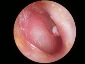 DSCN5842 A photo taken immediately following ventilation (grommet) insertion. It is placed into the antero-inferior aspect of the ear drum.